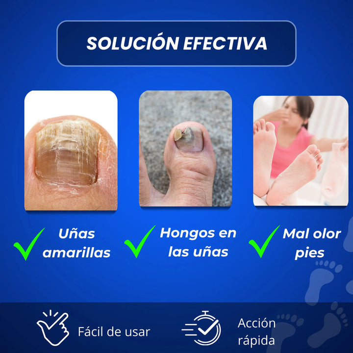 SUERO PARA ELIMINAR HONGO EN UÑAS